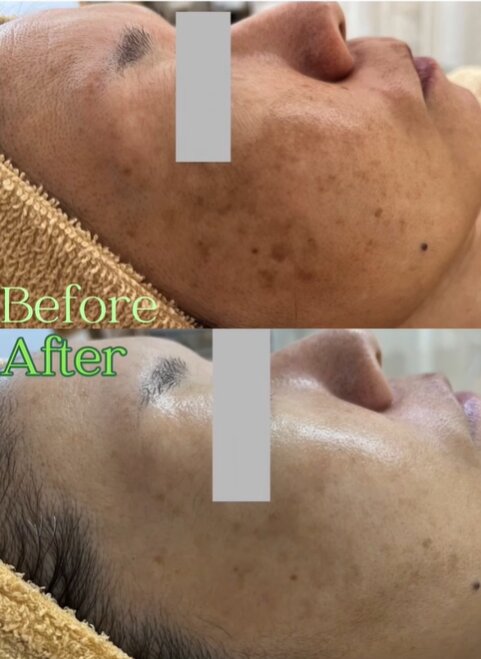 【肌質改善】before/after②|Apple. 宇都宮店【アップル】