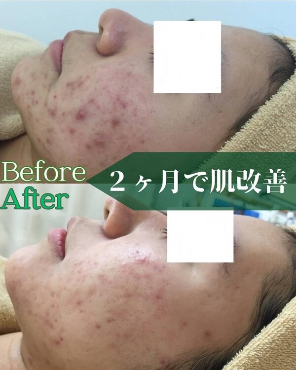 【肌質改善】before/after③|Apple. 宇都宮店【アップル】
