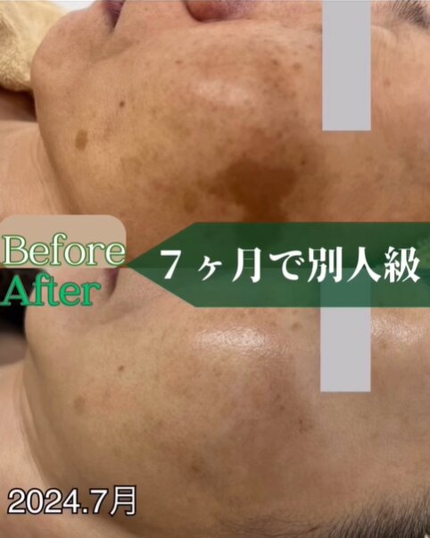 【肌質改善】before/after④|Apple. 宇都宮店【アップル】