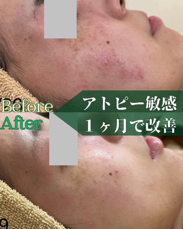 【肌質改善】before/after⑤|Apple. 宇都宮店【アップル】
