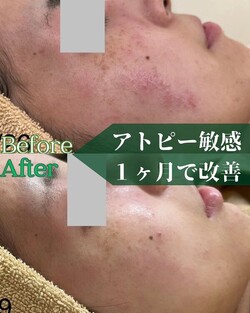 【肌質改善】before/after⑤|Apple. 宇都宮店【アップル】