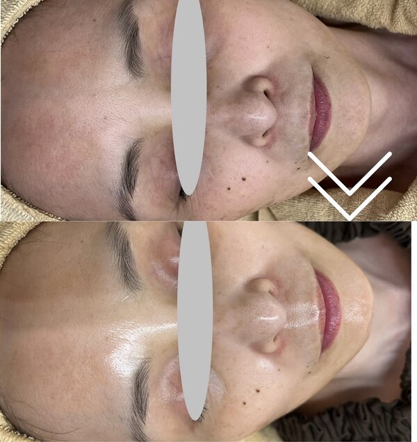 【レチノールピール】before/after①|Apple. 宇都宮店【アップル】