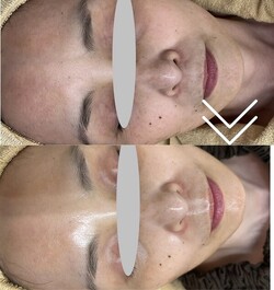 【レチノールピール】before/after①|Apple. 宇都宮店【アップル】