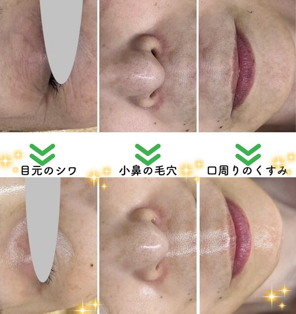 【レチノールピール】before/after②|Apple. 宇都宮店【アップル】