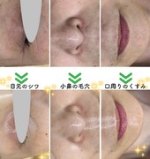 【レチノールピール】before/after②|Apple. 宇都宮店【アップル】