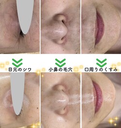 【レチノールピール】before/after②|Apple. 宇都宮店【アップル】