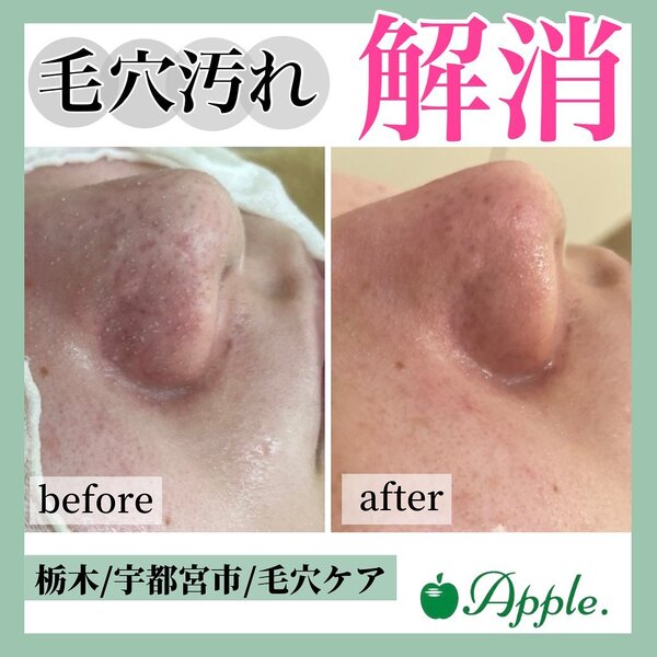 【毛穴ケア】before/after②|Apple. 宇都宮店【アップル】