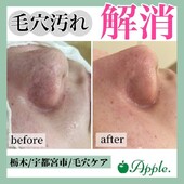 【毛穴ケア】before/after②|Apple. 宇都宮店【アップル】