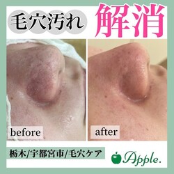 【毛穴ケア】before/after②|Apple. 宇都宮店【アップル】