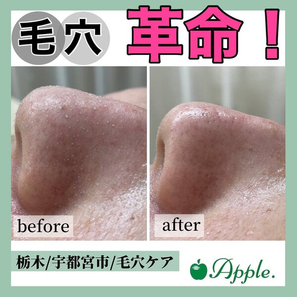 【毛穴ケア】before/after③|Apple. 宇都宮店【アップル】