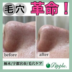 【毛穴ケア】before/after③|Apple. 宇都宮店【アップル】
