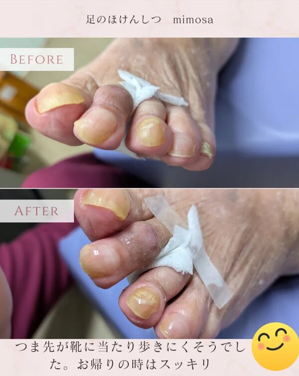 つま先のお手入れ✨|足のほけんしつ mimosa