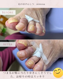 つま先のお手入れ✨|足のほけんしつ mimosa
