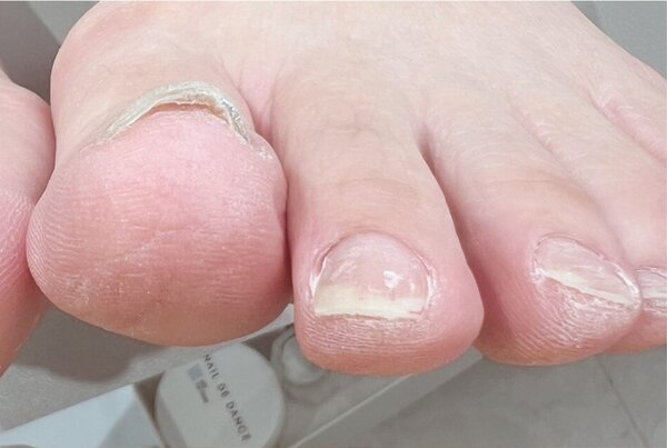 「フット ラメワンカラー+巻き爪ジェル」お爪のカタチや巻き爪、深爪を美しい形へ導きジェルを楽しめます|Nail Salon Linda