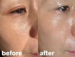 RE:Z BLUE【before/after】|Muse factory Beauty【ミューズファクトリービューティー】