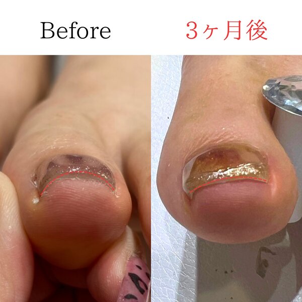 巻き爪矯正|Muse factory【ミューズファクトリー】