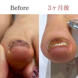 巻き爪矯正|Muse factory【ミューズファクトリー】