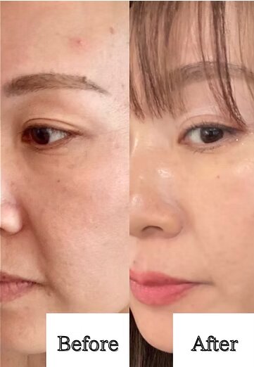 ダイヤモンドコーティングスピキュール【before/after】|Muse factory Beauty【ミューズファクトリービューティー】