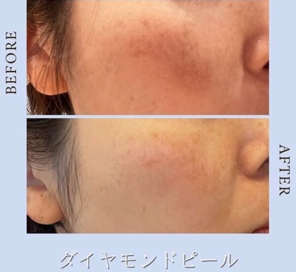 ダイヤモンドコーティングスピキュール【before/after】|Muse factory Beauty【ミューズファクトリービューティー】