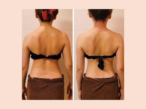 温熱筋膜リリース