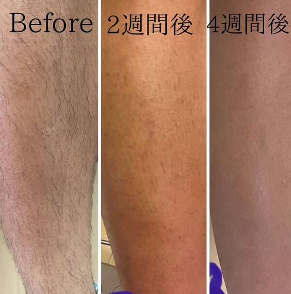 脱毛|トータルビューティーサロン COCO