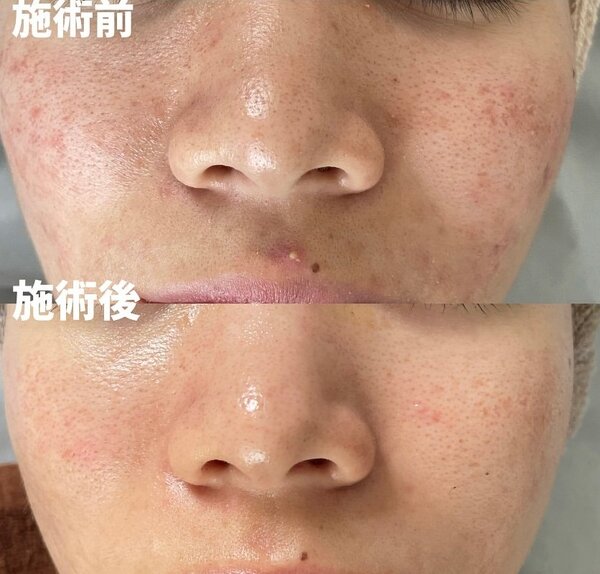 【ハーブピーリング】ビフォーアフター②|トータルビューティーサロン COCO