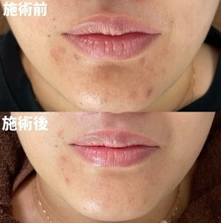 【ハーブピーリング】ビフォーアフター①