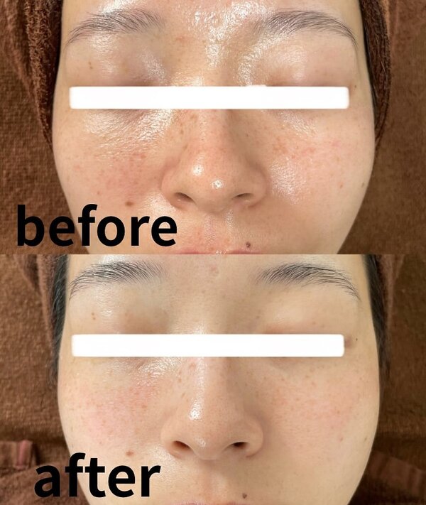 【フォトフェイシャル】ビフォーアフター②|トータルビューティーサロン COCO