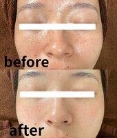 【フォトフェイシャル】ビフォーアフター②|トータルビューティーサロン COCO