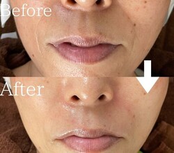 【フォトフェイシャル】ビフォーアフター①