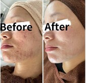 フォトフェイシャル＋ハーブピーリング|トータルビューティーサロン COCO