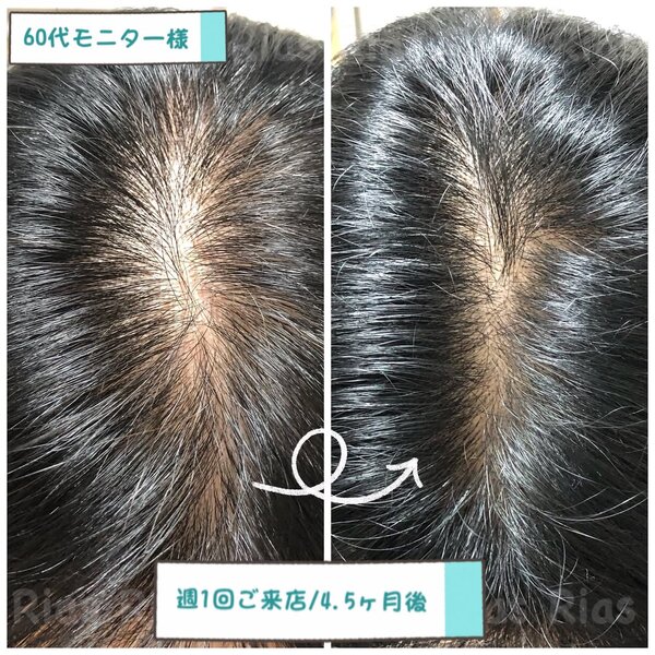 育毛ケアもお気軽にご相談ください！|Rias