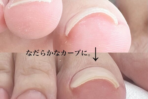 「巻き爪矯正」巻き爪ケア2回目です。 少しずつカーブがおだやかになっていきます。|Nail Salon Linda