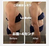 脂肪冷却①|エステサロン La Bella
