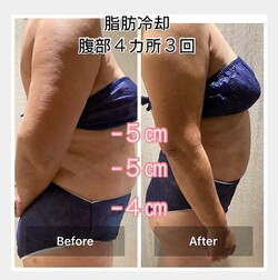 脂肪冷却②|エステサロン La Bella