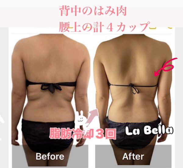 脂肪冷却③|エステサロン La Bella