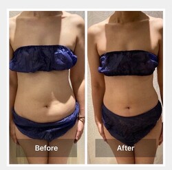 脂肪冷却④|エステサロン La Bella