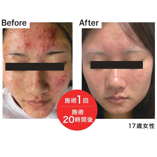 施術20時間後|エステサロン La Bella