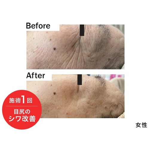 目尻のシワ改善