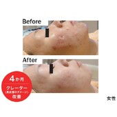 クレーター（真皮層のダメージ）改善|エステサロン La Bella