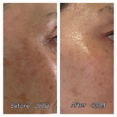 シミケア☆彡|エステサロン Nanea