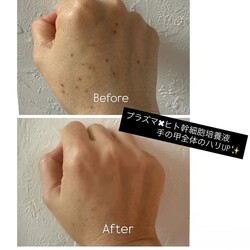 プラズマ✖️ヒト幹細胞培養液|エステサロン Nanea