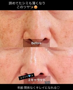 ダイヤモンドピール✨|エステサロン Nanea