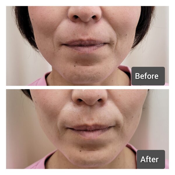  顔筋小顔コース|美と健康のサロン ナルミ