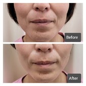  顔筋小顔コース|美と健康のサロン ナルミ