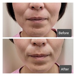  顔筋小顔コース