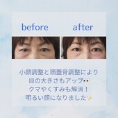 リフトアップ小顔コース|小顔サロン藍