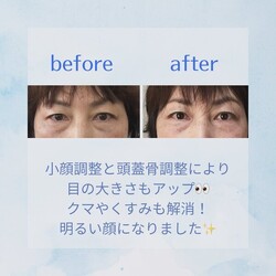 リフトアップ小顔コース|小顔サロン藍