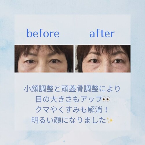 リフトアップ小顔コース