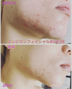 エンビロンフェイシャル80分|肌質改善エステサロン Amaryllis池袋店